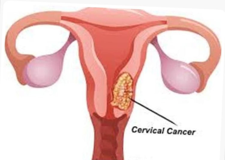 Gukingira kanseri y'inkondo y'umura mu bangavu bigabanya ibyago byo kuyirwara